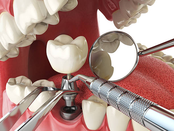 Best Emergency Treatment for Dental Infections or Abscesses in Portsmouth, NH
